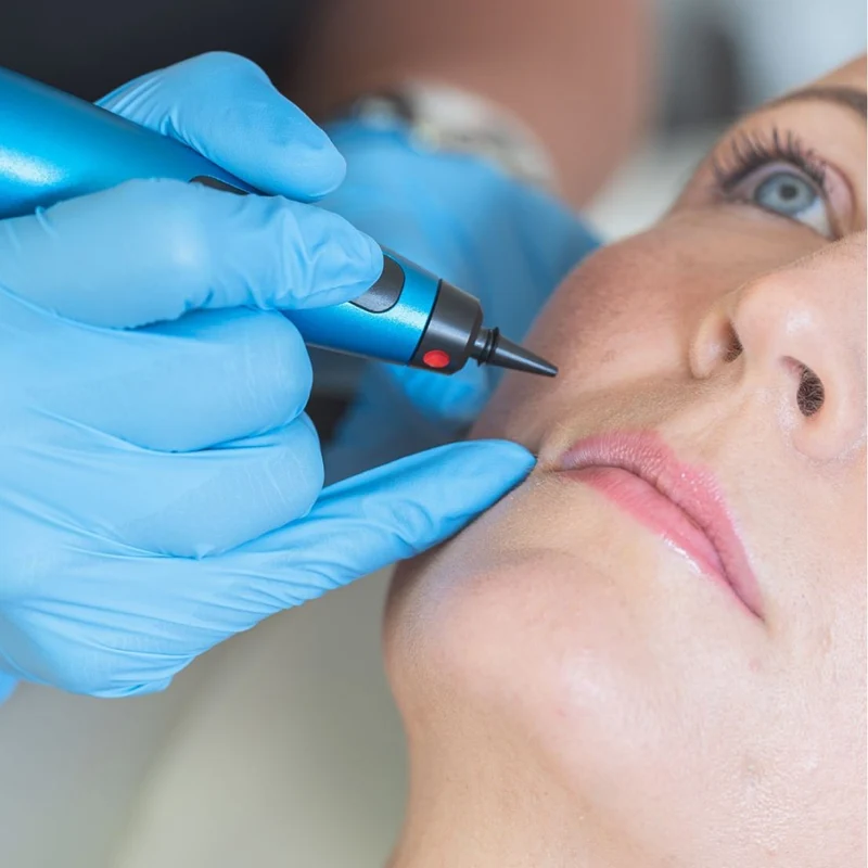 CryoPen treatment being carried out at close range