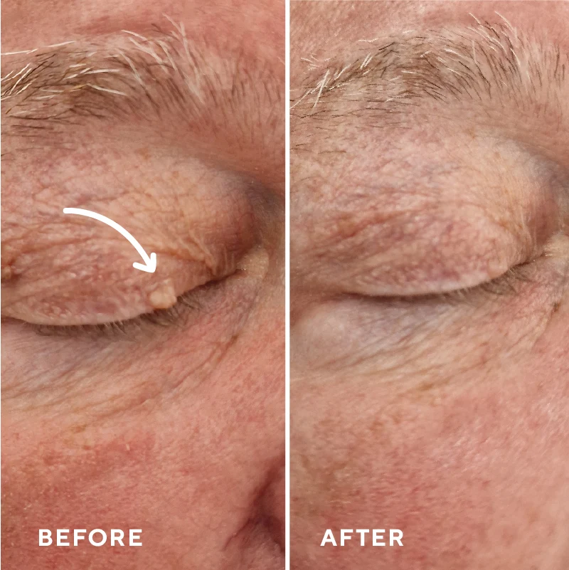 Before and after CryoPen treatment of a small eyelid lesion