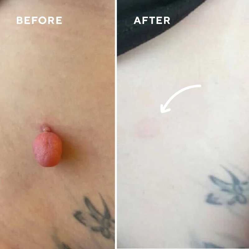 Before and after CryoPen treatment of a skin tag