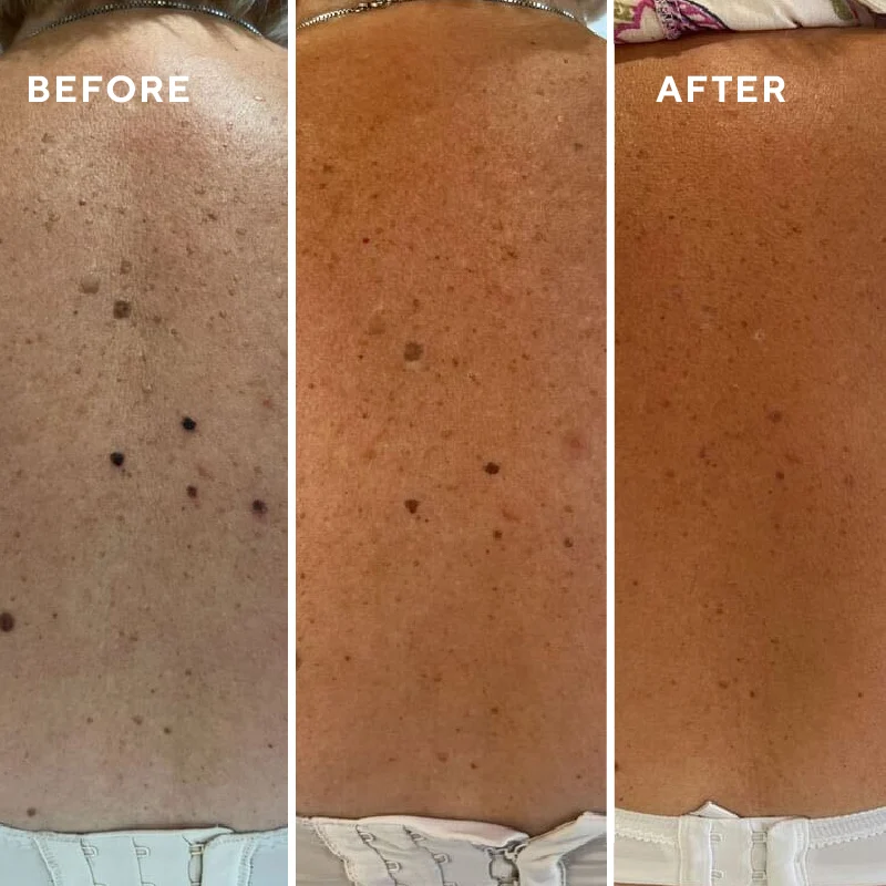 Before and after stages following CryoPen lesion treatment