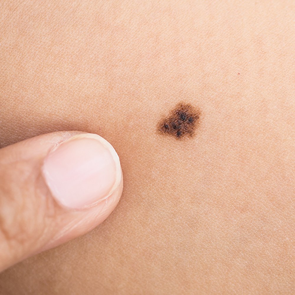 Close-up view of a mole for professional screening